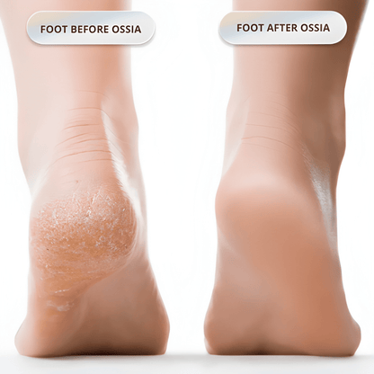 Ossia™ Silk 3 Pro Plus